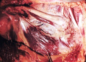 Natural color photograph of superficial dissection of the thoracic wall, emphasizing the right clavicular region