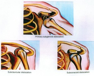 Series of illustrations of the left glenohumeral joint, anterior view, showing the relationships between major bone structures in subclavicular, primary subglenoid, and subcoracoid dislocations