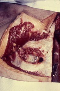 Natural color photograph of dissection of the upper right quadrant of the thorax, anterior view, with the skin and superficial muscle layers retracted to expose the second and third rib, internal thoracic vein and artery, and deeper muscle layers