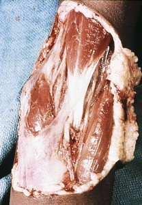 Natural color photograph of dissection of the left cubital fossa