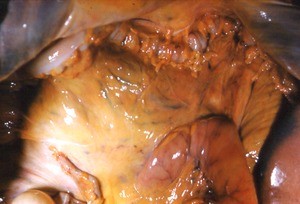 Natural color photograph of dissection of the peritoneal cavity, anterior view, showing abdominal viscera and associated mesentery