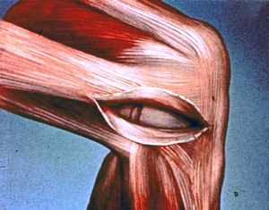 Illustration of right knee in flexion, with iliotibial tract incised to expose interior of knee joint cavity