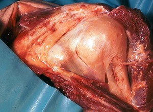 Natural color photograph of dissection of the left shoulder, anterior view, with the deltoid muscle reflected to expose the surgical neck of the humerus, the axillary nerve, and the fibrous capsule of the glenohumeral joint