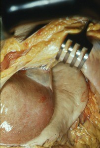 Natural color photograph of dissection of the abdominal cavity, anterior view, showing the liver overlying the stomach