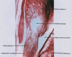 Natural color photograph of dissection of the left gluteal region, posterior view, emphasizing the greater trochanter and associated structures, with the gluteus maximus muscle cut and reflected