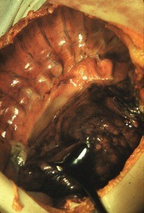 Natural color photograph of dissection of the right pleural cavity, anterior view, with the anterior rib cage removed and lung retracted to expose the posterior wall