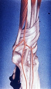 Illustration of dissected right wrist, emphasizing radial artery's branching in relation to extensor retinaculum