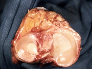 Natural color photograph of dissection of the left tibial table, showing medial and lateral menisci