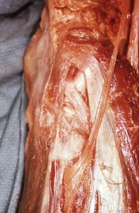 Natural color photograph of dissection of the left knee, lateral view, showing the common fibular nerve and it passes inferior to the head of the fibula