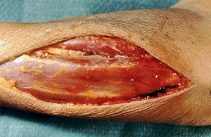 Natural color photograph of dissection of the forearm