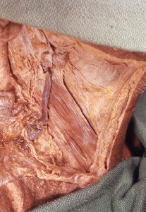 Natural color photograph of dissection of the right side of the neck, anterolateral view, showing the right external jugular vein running over the right sternocleidomastoid muscle