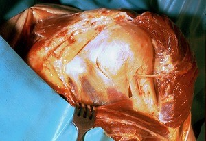 Natural color photograph of dissection of the left shoulder, anterior view, with the deltoid muscle retracted to show muscles, nerves, and bone