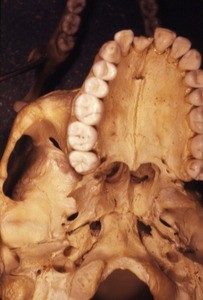 Color photograph of the inferior aspect of the skull