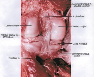 Natural color photograph of left knee, posterior view, showing bones, muscles, tendon, meniscus and ligament