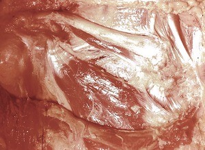 Natural color photograph of dissection of the right shoulder, anterior view, with the pectoralis major muscle removed to expose the pectoralis minor muscle