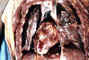 Natural color photograph of dissection of the thorax, anterior view, with the pericardium opened to reveal the heart