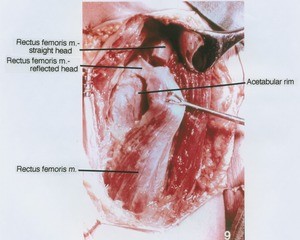 Natural color photograph of dissection of left hip joint, anterior view, with the rectus femoris cut and reflected