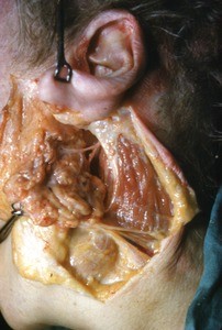 Natural color photograph of dissection of the face, left lateral view, exposing the facial nerve as it exits the stylomastoid foramen