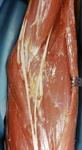 Natural color photograph of dissection of the left cubital fossa, anterior view