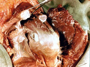 Natural color photograph of dissection of the left shoulder, superolateral view, with the deltoid muscle reflected and acromion removed to expose the glenohumeral joint capsule and supraspinatus muscle