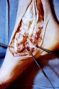 Natural color photograph of dissection of the right ankle, medial view