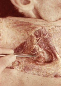 Natural color photograph of dissection of the right side of the neck, lateral view, showing nerves and muscles