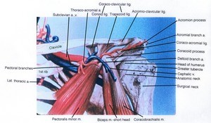 Illustration of the left shoulder, anterior view, showing major arteries and veins, the pectroalis minor and biceps muscles, bone structure, and ligaments