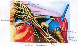 Illustration of dissection of the left brachial plexus