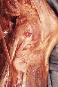 Natural color photograph of dissection of the right knee, lateral view, showing the fibular collateral ligament, the popliteus tendon and the common fibular nerve