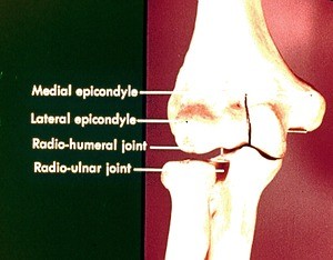 Color photograph of articulated bones of left elbow, palmar (anterior) aspect, showing medial and lateral humoral epicondyles, radio-humoral joint, proximal radio-ulnar joint