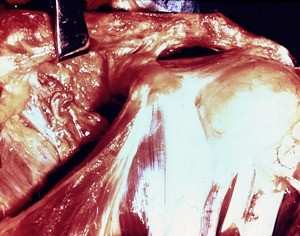 Natural color photograph of dissection of the left shoulder, anterior view, with the clavicle retracted from the coracoid process to show the connective tissue attachments to the coracoid process