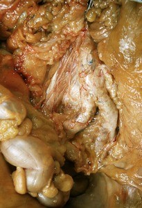 Natural color photograph of dissection of peritoneal cavity, anterior view, showing abdominal viscera and nervous innervation