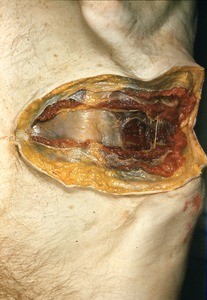 Natural color photograph of dissection of the left lower quadrant of the abdomen, anterior view, showing the tissue layers of the abdomen down to the level of the transverse abdominal muscle