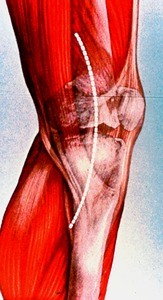Illustration of right knee from medial aspect, with white dashed line indicating site of surgical incision to expose interior of joint or perform joint replacement