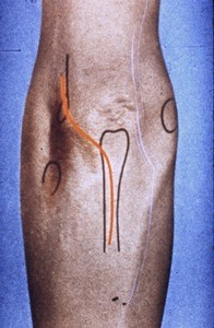 Illustration of surface anatomy of posterior surface of left arm