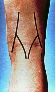 Illustration of surface anatomy of right knee, posterior, with lines indicating outline of popliteal fossa as well as head of fibula