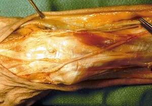 Natural color photograph of dissection of the left wrist and forearm, dorsal view, with the skin retracted to show the cutaneous branches of the medial and radial nerves