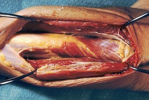 Natural color photograph of dissection of the forearm