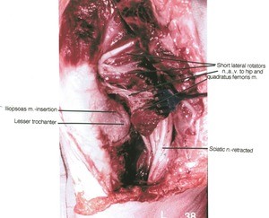 Natural color photograph of dissection of muscles of the left gluteal region, posterior view, with the gluteus maximus muscle cut and reflected