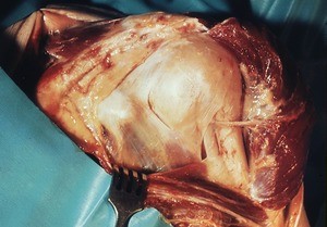 Natural color photograph of dissection of the right shoulder, posterior view, with the deltoid muscle reflected and rotator cuff muscles removed to expose the axillary nerve as it courses around the surgical neck of the humerus