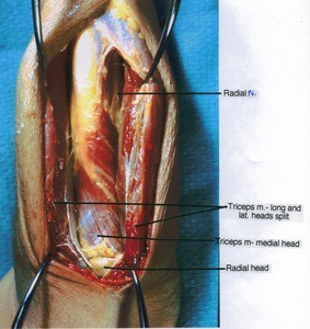 Natural color photograph of right arm, posterior view, showing muscles, bone and nerve with the tricep long and lateral head split