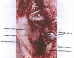 Natural color photograph of left hip, posterior view showing muscles, tendon and bone with the quadratus femoris cut and retracted