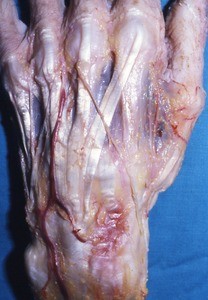 Natural color photograph of dissection of the dorsal surface of the left hand