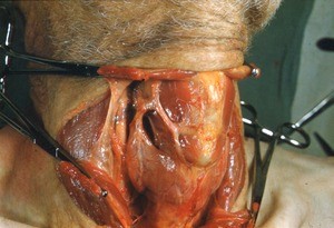 Natural color photograph of dissection of the neck, anterior view, showing the thyroid gland with the sternocleidomastoid muscle cut and reflected