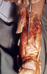 Natural color photograph of dissection of the right knee, anterior view, with the patella reflected to expose the muscles and ligaments of the knee