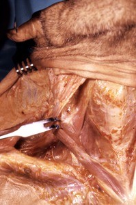 Natural color photograph of dissection of the neck, anterior view, with the right sternocleidomastoid muscle reflected to expose the right sternohyoid and omohyoid muscles