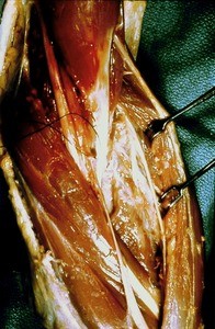 Natural color photograph of dissection of the left cubital fossa, anteromedial view