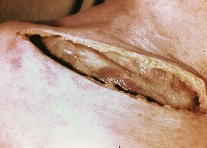 Natural color photograph of dissection of the right upper chest, anterior view, showing an incision along the clavicle