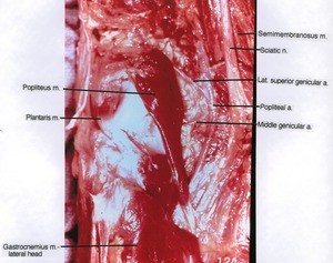 Natural color photograph of left knee, posterior view, showing muscles, arteries and nerve