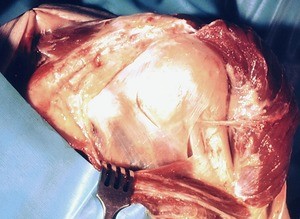 Natural color photograph of dissection of the left shoulder, anterior view, with the deltoid muscle reflected to reveal the surgical neck of the humerus and axillary nerve